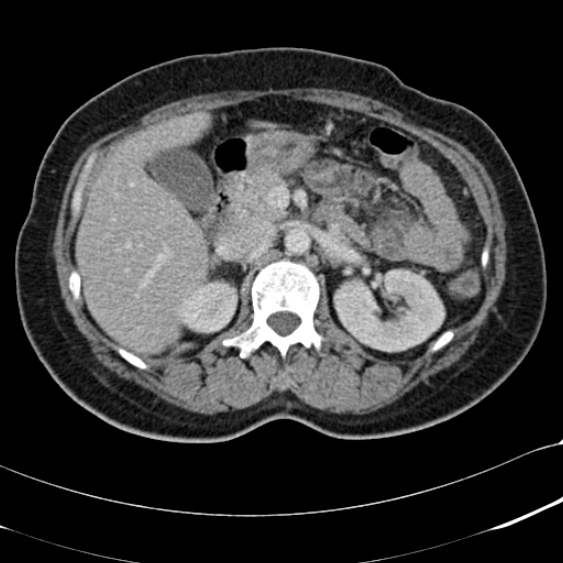 Acute appendicitis (Radiopaedia 48792-53822 Axial C+ portal venous phase 39).jpg