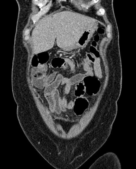 File:Acute appendicitis (Radiopaedia 48792-53822 Coronal C+ portal venous phase 58).jpg