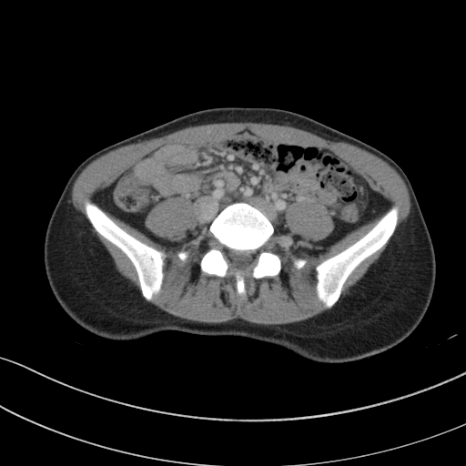 Acute appendicitis (Radiopaedia 62608-70901 Axial C+ portal venous phase 3).jpg