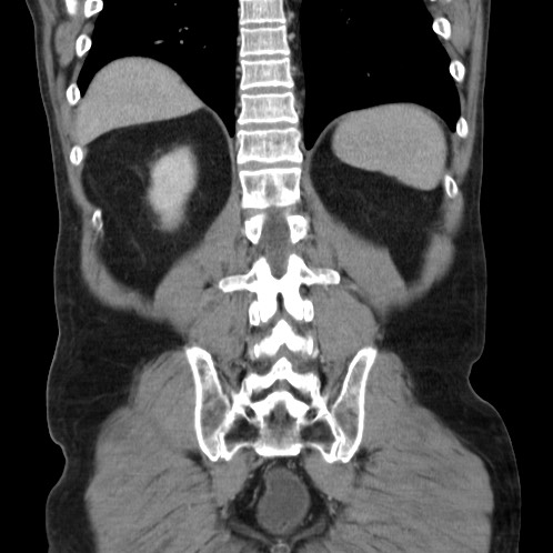 Acute appendicitis (Radiopaedia 66513-75790 Coronal C+ portal venous phase 71).jpg