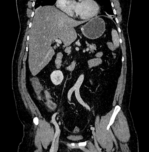 Acute appendicitis (Radiopaedia 79950-93224 Coronal C+ portal venous phase 44).jpg