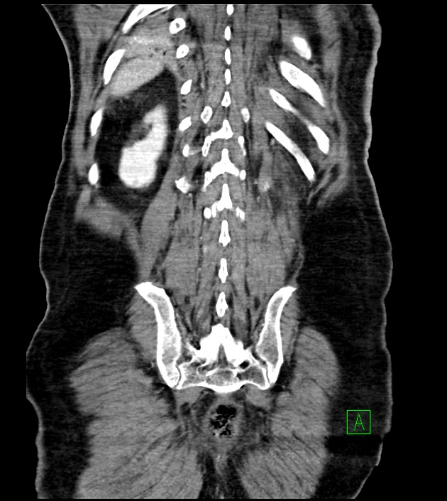Acute arterial mesenteric ischemia (Radiopaedia 78238-90828 Coronal C+ portal venous phase 76).jpg