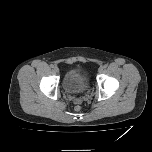 Acute aspiration pneumonitis (Radiopaedia 55642-62166 Axial liver window 65).jpg