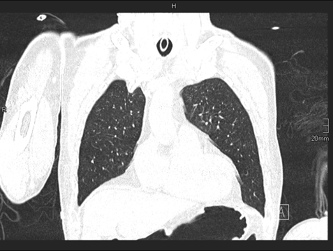 Acute aspiration pneumonitis (Radiopaedia 55642-62166 Coronal lung window 25).jpg