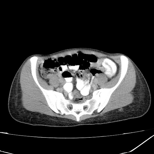 Acute bilateral pyelonephritis (Radiopaedia 74153-84969 Axial C+ portal venous phase 38).jpg
