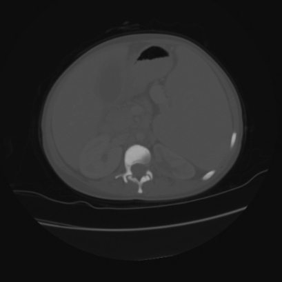 File:Acute calculous cholecystitis in patient with osteopetrosis (Radiopaedia 77871-90159 Axial bone window 20).jpg