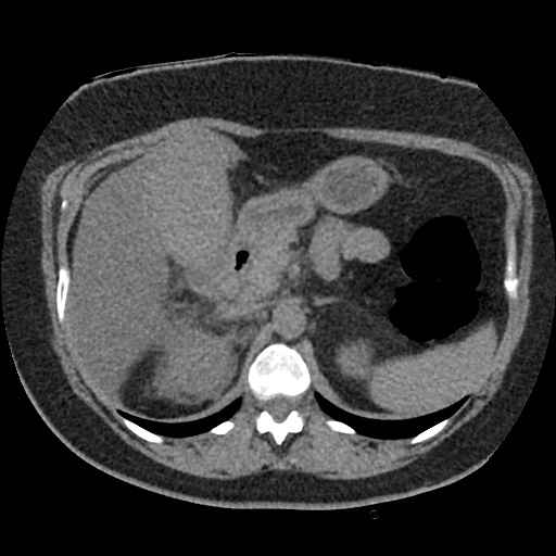 File:Acute cholecystitis and ureteric colic (Radiopaedia 42330-45444 Axial prone 27).jpg