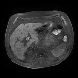 Acute cholecystitis complicated by pylephlebitis (Radiopaedia 65782-74915 Axial T1 fat sat 39).jpg