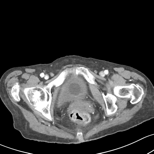 Acute cholecystitis with contained perforation (Radiopaedia 47328-51907 Axial C+ portal venous phase 71).png