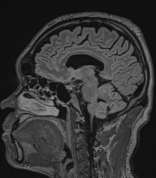 Acute disseminated encephalomyelitis (ADEM)- Anti-NMDA receptor encephalitis (Radiopaedia 54920-61201 Sagittal FLAIR 48).png