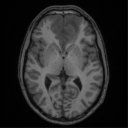 Acute disseminated encephalomyelitis (ADEM) (Radiopaedia 65319-74349 Axial T1 32).png