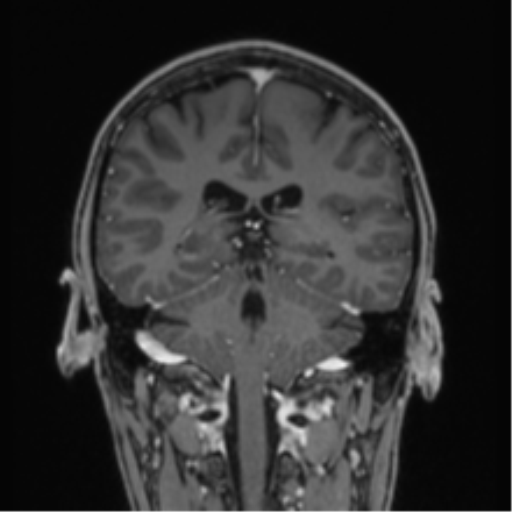 Acute disseminated encephalomyelitis (ADEM) (Radiopaedia 65319-74349 Coronal T1 C+ 13).png
