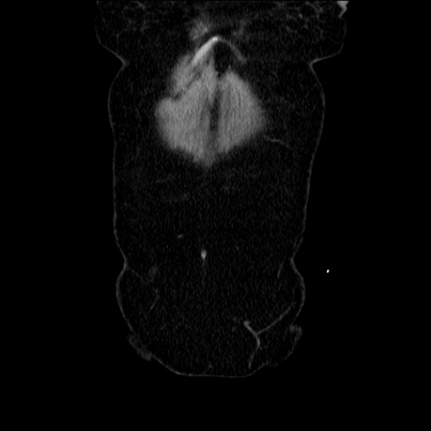 Acute diverticulitis (Radiopaedia 34183-35442 Coronal C+ portal venous phase 10).jpg