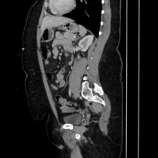 Acute diverticulitis - transverse colon (Radiopaedia 87063-103327 Sagittal C+ portal venous phase 143).jpg