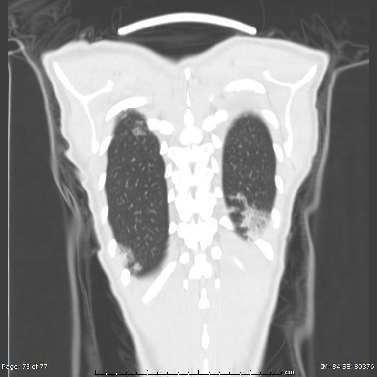 Acute eosinophilic pneumonia (Radiopaedia 48211-53073 Coronal lung window 50).jpg
