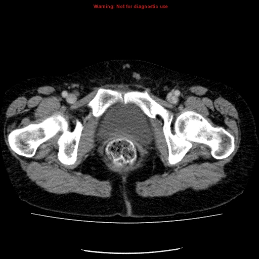 Acute gangrenous cholecystitis (Radiopaedia 10123-10661 Axial C+ portal venous phase 101).jpg