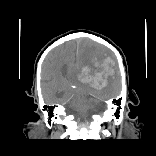 Acute hemorrhagic stroke (Radiopaedia 17507-17223 Coronal non-contrast 33).jpg