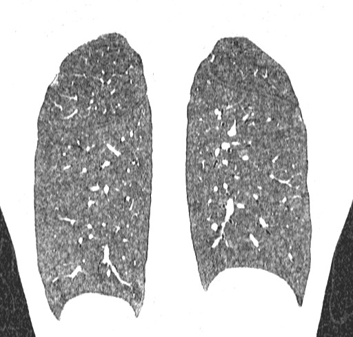 Acute hypersensitivity pneumonitis (Radiopaedia 85293-100870 Coronal lung window 104).jpg