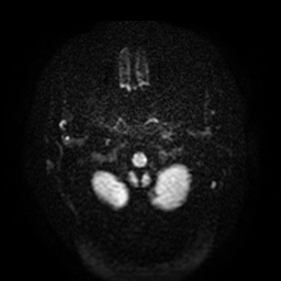 Acute internal carotid artery dissection (Radiopaedia 53541-59632 Axial DWI 3).jpg