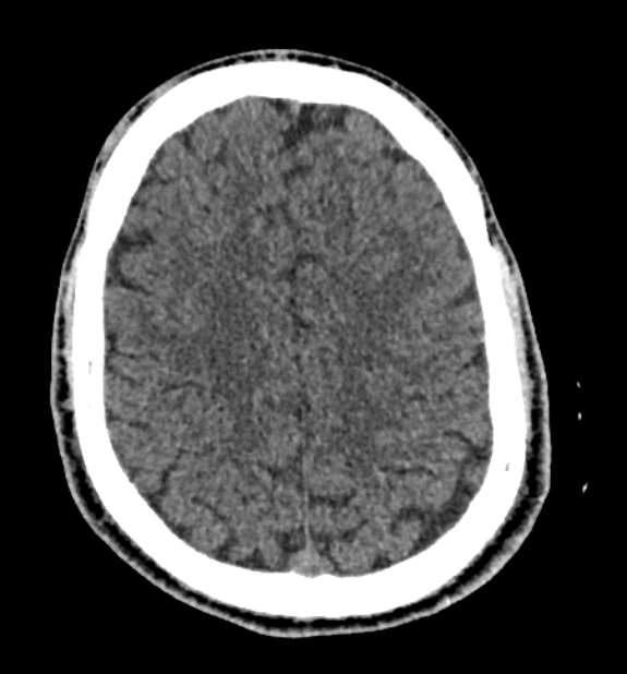Acute ischemic stroke - posterior circulation territory (Radiopaedia 77670-89881 non-contrast 68).jpg