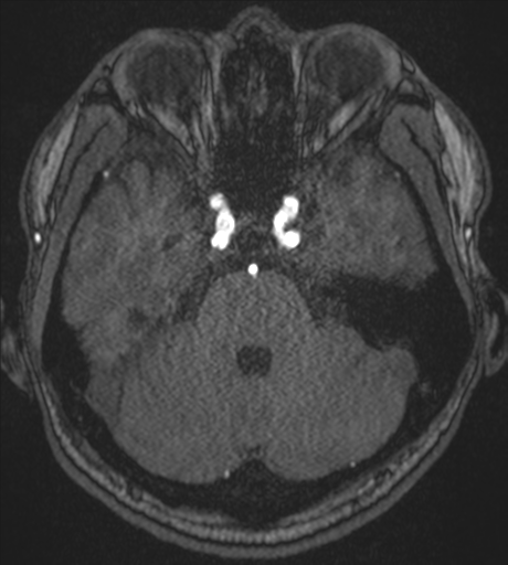 Acute left middle cerebral artery territory infarct with clot retrieval (Radiopaedia 47732-52433 Axial MRA 18).png
