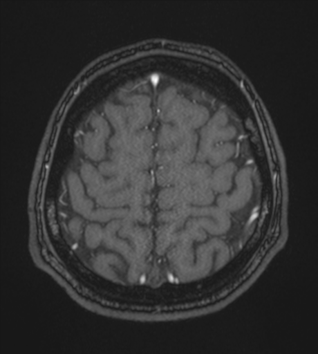 Acute left middle cerebral artery territory infarct with clot retrieval (Radiopaedia 47732-52433 Axial MRA 57).png