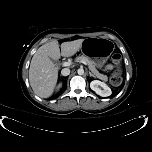 Acute myocardial infarction in CT (Radiopaedia 39947-42415 Axial C+ portal venous phase 40).jpg