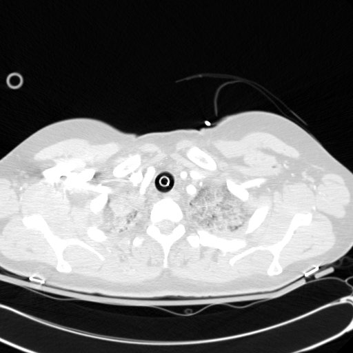 File:Acute myocardial infarction in CT (Radiopaedia 39947-42415 Axial lung window 11).jpg