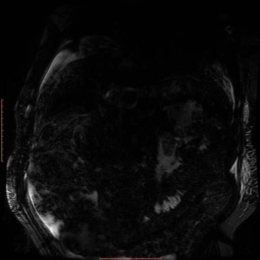 Acute necrotizing pancreatitis (Radiopaedia 28194-28448 Coronal MRCP 57).jpg