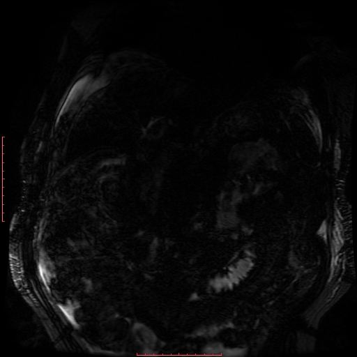 File:Acute necrotizing pancreatitis (Radiopaedia 28194-28448 Coronal MRCP 64).jpg