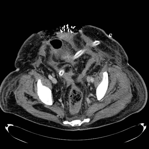 Acute pancreatic necrosis (Radiopaedia 13560-18503 Axial C+ portal venous phase 71).jpg