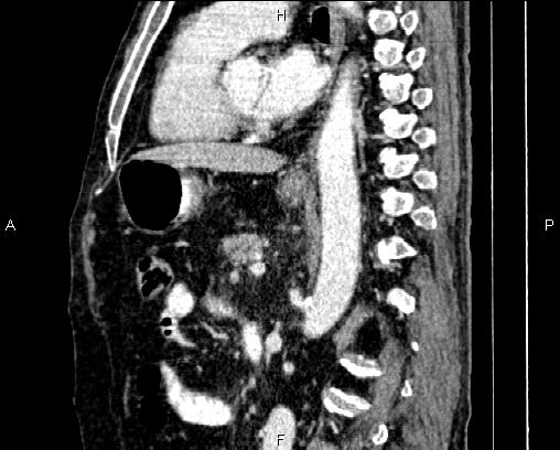 Acute pancreatitis (Radiopaedia 85146-100701 Sagittal C+ portal venous phase 54).jpg