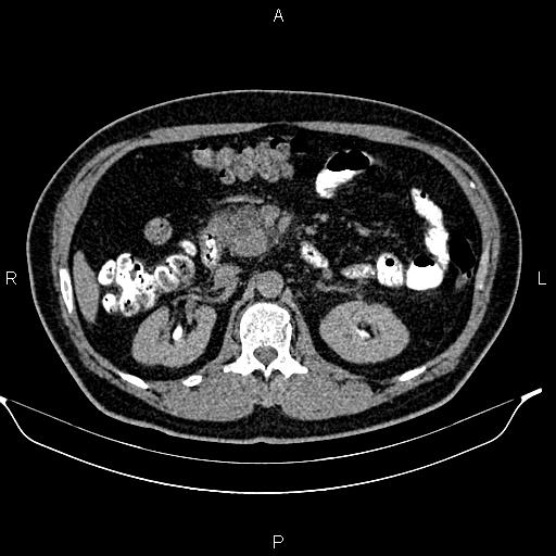 Acute pancreatitis (Radiopaedia 85390-101010 Axial C+ delayed 31).jpg