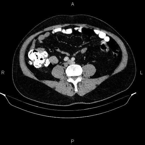 Acute pancreatitis (Radiopaedia 85390-101010 Axial C+ portal venous phase 69).jpg