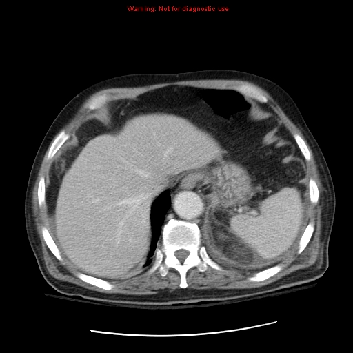 File:Acute pancreatitis with incidental pancreatic lipoma (Radiopaedia 10190-10730 Axial C+ portal venous phase 11).jpg
