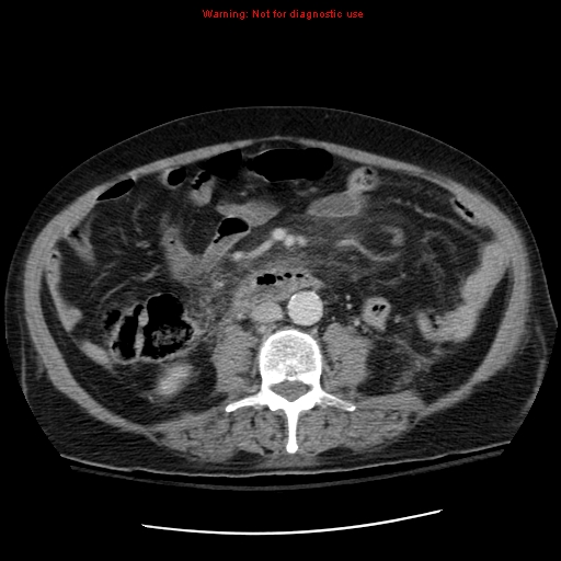 File:Acute pancreatitis with incidental pancreatic lipoma (Radiopaedia 10190-10730 Axial C+ portal venous phase 40).jpg