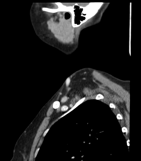File:Acute parotitis (Radiopaedia 27425-27619 Sagittal C+ portal venous phase 50).png