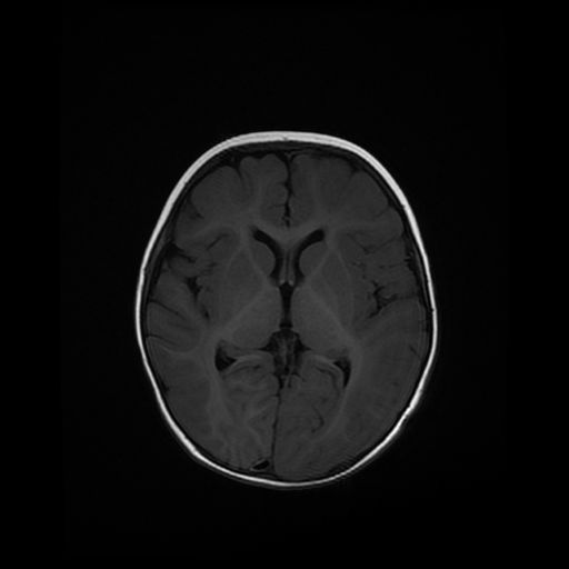 File:Acute phase of hemiconvulsion-hemiplegia epilepsy syndrome (Radiopaedia 29309-29745 Axial T1 12).jpg