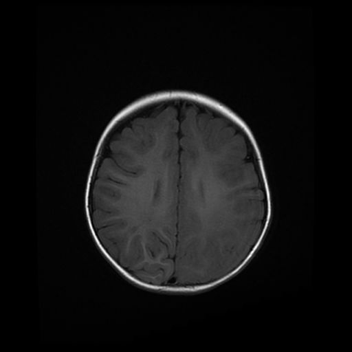 File:Acute phase of hemiconvulsion-hemiplegia epilepsy syndrome (Radiopaedia 29309-29745 Axial T1 8).jpg
