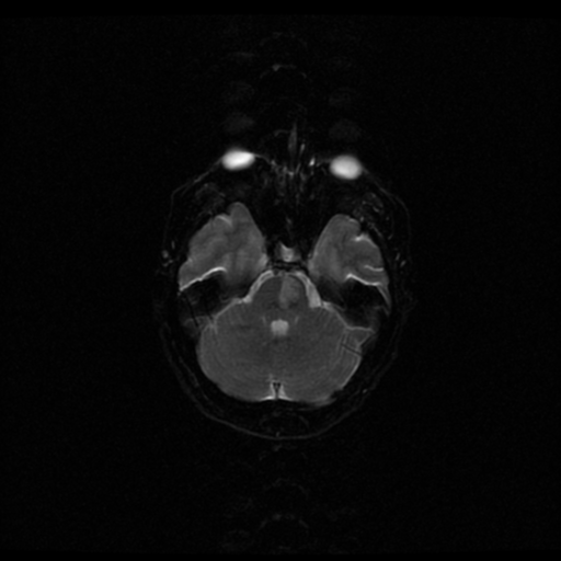 File:Acute pontine infarct from vertebral artery dissection (Radiopaedia 34111-35370 Axial Echo planar 5).png