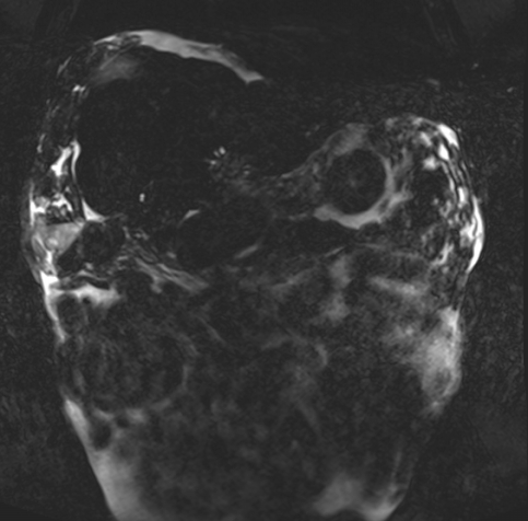 Acute portal vein thrombosis (Radiopaedia 73198-83925 Coronal Heavily T2 thin cuts 2).jpg