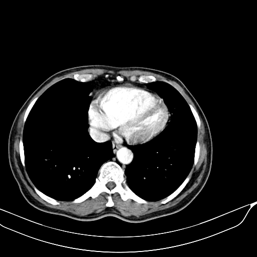 Acute pulmonary embolism (Radiopaedia 69510-79390 D 71).jpg