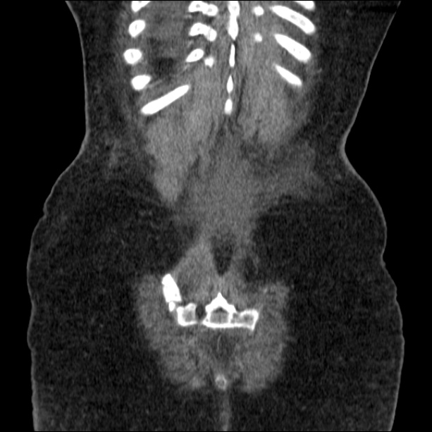 Acute pyelonephritis (Radiopaedia 26584-26729 C+ portal venous phase 67).jpg