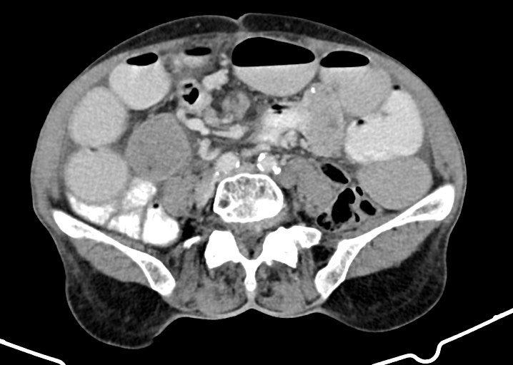 Acute small bowel (ileal) volvulus (Radiopaedia 71740-82139 Axial C+ portal venous phase 131).jpg