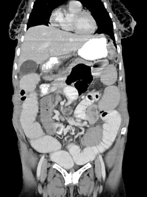Acute small bowel (ileal) volvulus (Radiopaedia 71740-82139 Coronal C+ portal venous phase 40).jpg