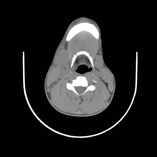 File:Acute submandibular sialadenitis secondary to ductal stone (Radiopaedia 27999-28267 Axial non-contrast 17).jpg