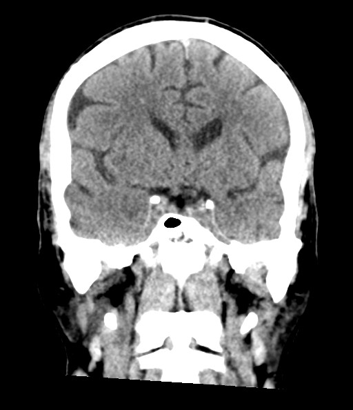 File:Acute superior cerebellar artery territory infarct (Radiopaedia 84104-99359 Coronal non-contrast 44).jpg