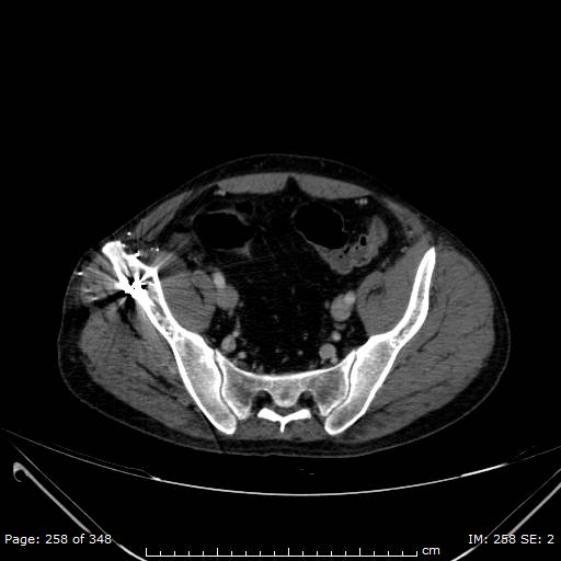 Acute superior mesenteric artery occlusion (Radiopaedia 43636-47060 Axial C+ portal venous phase 50).jpg