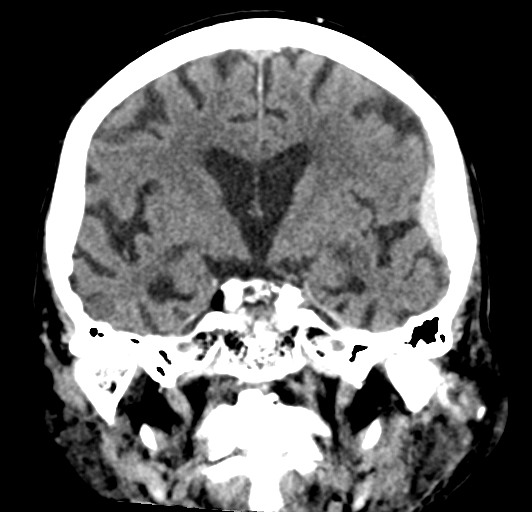 File:Acute traumatic subdural hematoma (Radiopaedia 82921-97257 Coronal non-contrast 45).jpg