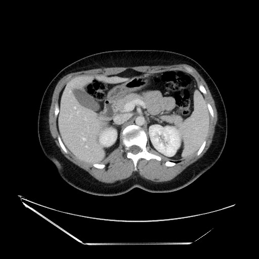 Acute uncomplicated appendicitis (Radiopaedia 73704-84499 Axial C+ portal venous phase 48).jpg